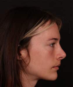 Revision Rhinoplasty