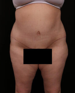 Liposuction