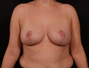 Mastopexy (Breast Lift)