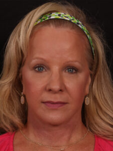 Lower Facelift and Blepharoplasty