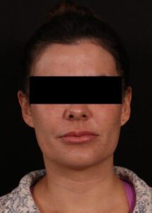 Neck Liposuction