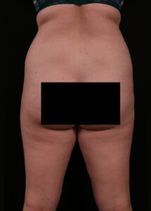 Liposuction