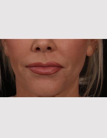 Lip Lift