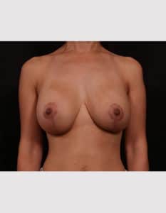 Breast Lift with Augmentation