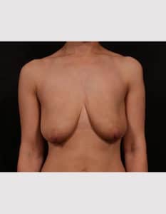 Breast Lift with Augmentation