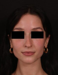 Rhinoplasty