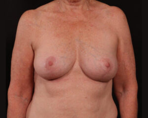 Mastopexy (Breast Lift)