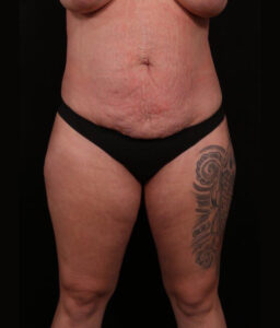 Tummy Tuck (Abdominoplasty)