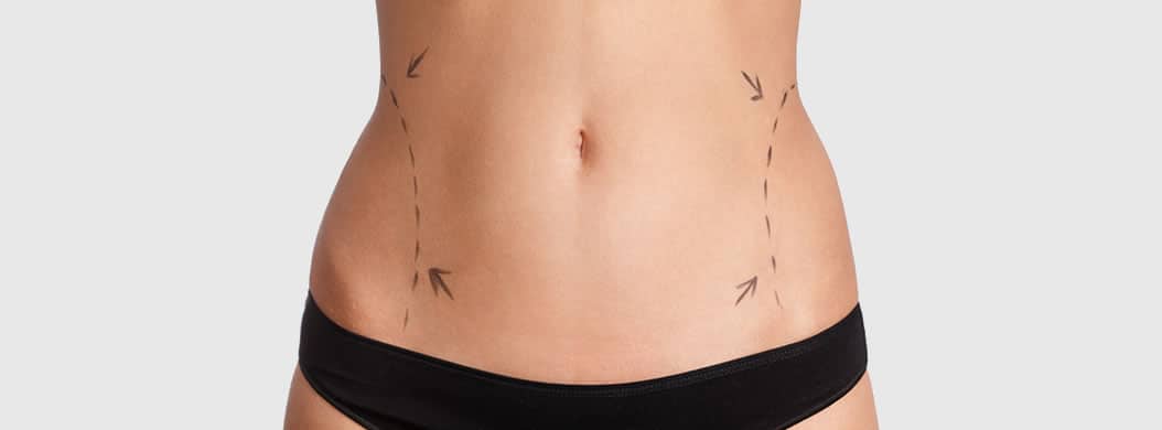 woman’s bare stomach marked with dotted lines and arrows on the sides for liposuction