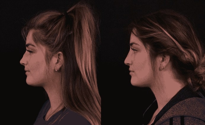 young woman’s side profile before and after non-surgical rhinoplasty with smoother and less rigid nose after procedure