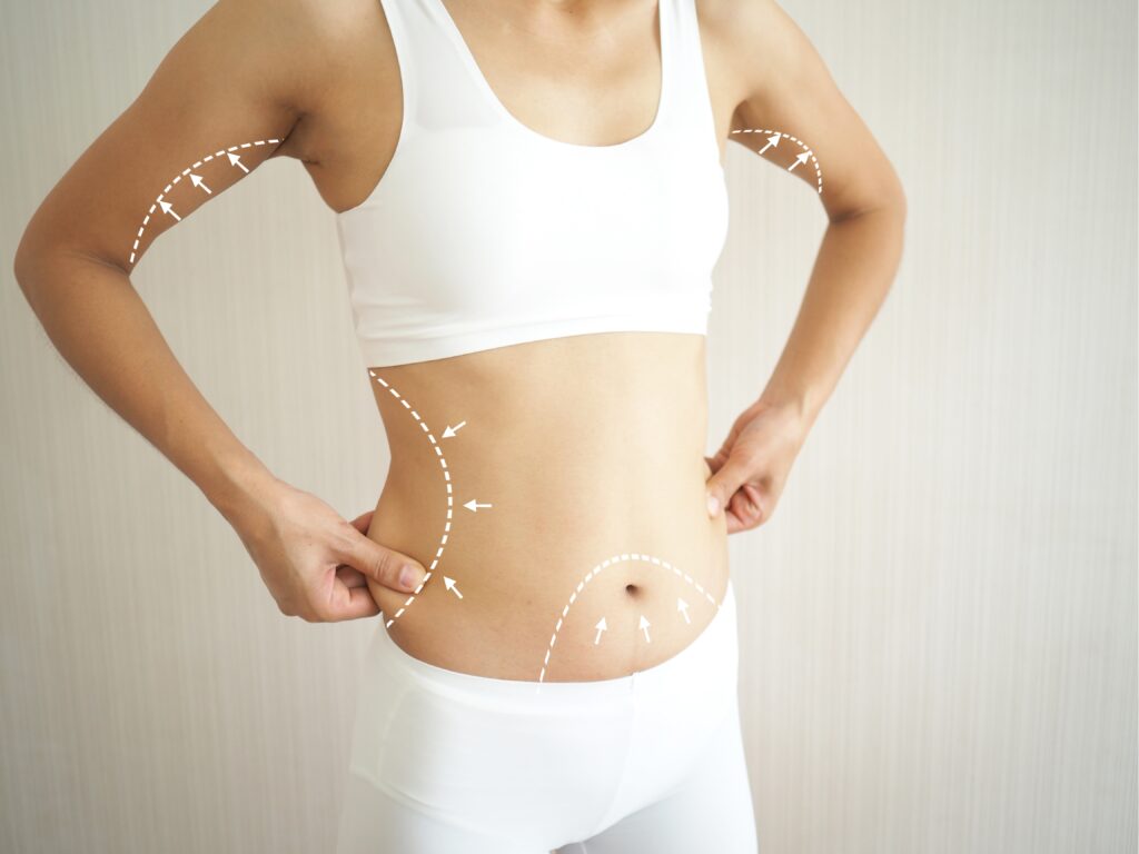 A woman in a white sports bra with lines showing where she wants a body lift procedure.